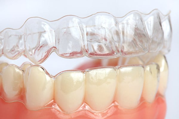 Aligneurs invisibles Invisalign, Dentisterie esthétique