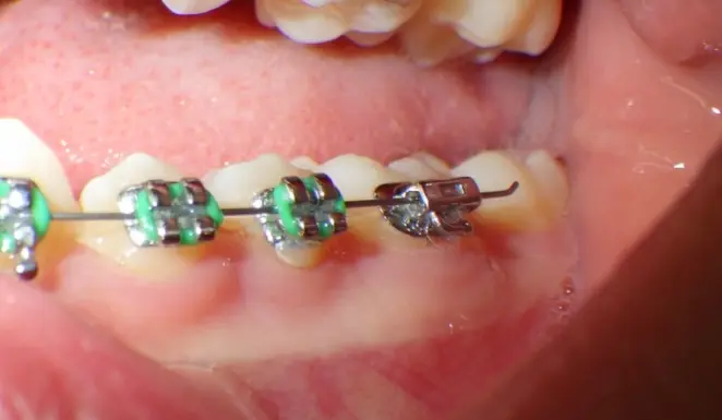 urgence orthodontique paris invisalign orthodontiste3