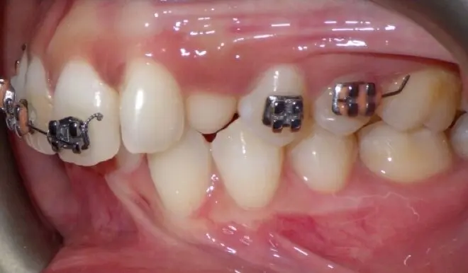 urgence orthodontique paris invisalign orthodontiste4
